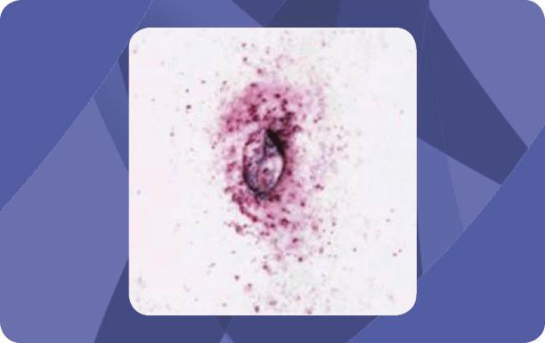 Mørkerødt udslæt på huden kaldet angiokeratom