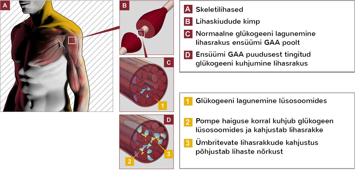 Pompe haiguse korral ei ole piisavalt ensüümi GAA